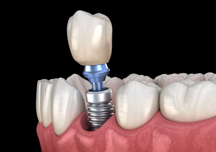 چگونه بهترین دندانپزشک برای ایمپلنت انتخاب کنیم؟